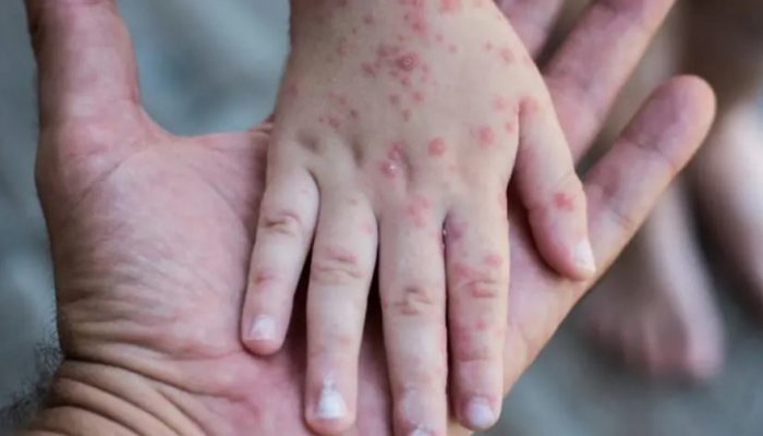 Kasus Cacar Monyet di Indonesia Meningkat, DPR Minta Vaksinasi Diperluas